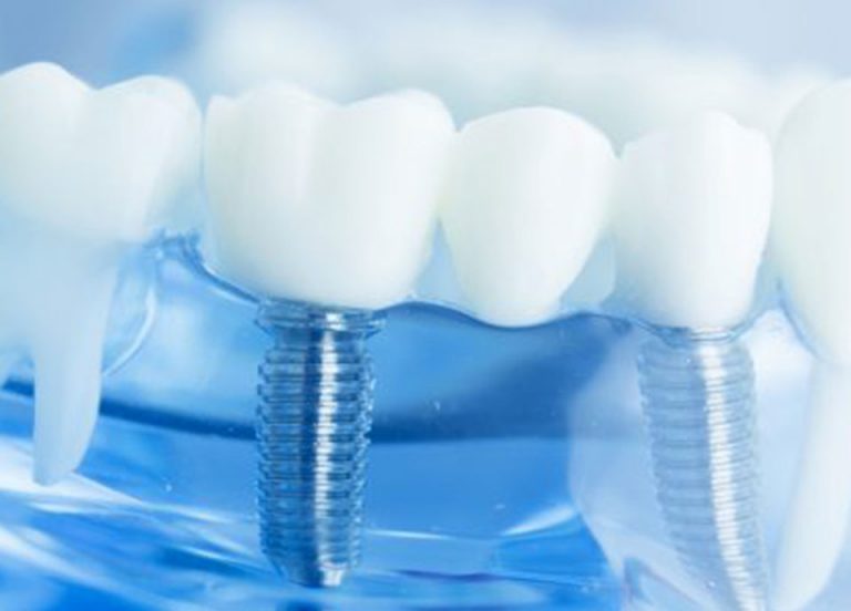 Implantologie Ulm | Zahnimplantate bei Zahnarzt Dr. Schröder